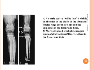 A, An early scurvy “white line” is visible
on the ends of the shafts of the tibia and
fibula; rings are shown around the
epiphyses of the femur and tibia.
B, More advanced scorbutic changes;
zones of destruction (ZD) are evident in
the femur and tibia
4/23/2023
63
Getnet
A.
 