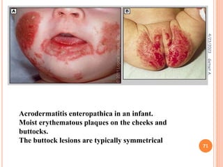 Acrodermatitis enteropathica in an infant.
Moist erythematous plaques on the cheeks and
buttocks.
The buttock lesions are typically symmetrical
4/23/2023
71
Getnet
A.
 