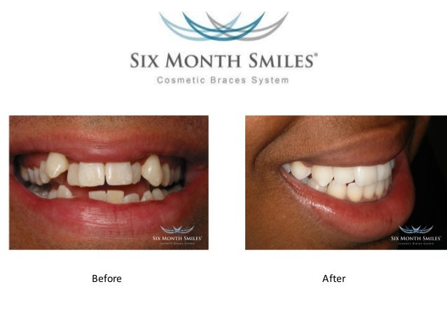 how to straighten one crooked tooth how to straighten one crooked tooth