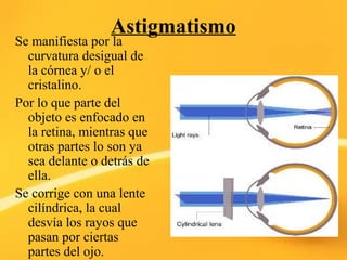 Tipos de astigmatismo y cómo se corrige