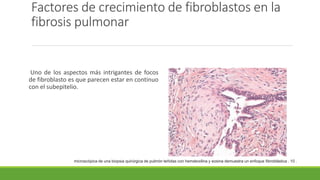 Factores de crecimiento de fibroblastos en la
fibrosis pulmonar
Uno de los aspectos más intrigantes de focos
de fibroblasto es que parecen estar en continuo
con el subepitelio.
microscópica de una biopsia quirúrgica de pulmón teñidas con hematoxilina y eosina demuestra un enfoque fibroblástica . 10 .
 