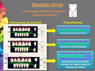 ¿Cual juego de dientes escojo con
respecto al ancho?
Alternativas de selección Procedimiento
Ancho dientes artificiales menor
que el ancho del paciente
ENFILADO CON DIASTEMAS
Ancho dientes artificiales mayor
que el ancho del paciente
DESGASTE INTERPROXIMAL
Ancho dientes artificiales menor
que el ancho del paciente de forma
diferente a la cara del paciente
ENFILADO CON DIASTEMAS
TALLADO DE LÍNEAS ANGULOS
MODIFICAR FORMA
50 mm
50 mm
50 mm
 