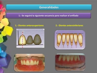 1.- Se seguirá la siguiente secuencia para realizar el enfilado
1.- Dientes anterosuperiores 2.- Dientes anteroinferiores
Generalidades
 