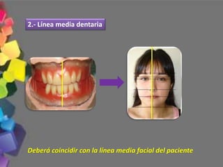 2.- Línea media dentaria
Deberá coincidir con la línea media facial del paciente
 