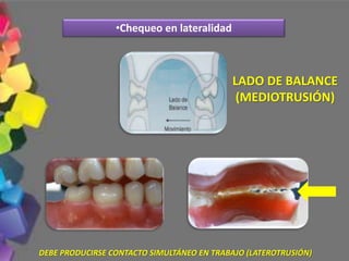 •Chequeo en lateralidad
LADO DE BALANCE
(MEDIOTRUSIÓN)
DEBE PRODUCIRSE CONTACTO SIMULTÁNEO EN TRABAJO (LATEROTRUSIÓN)
 