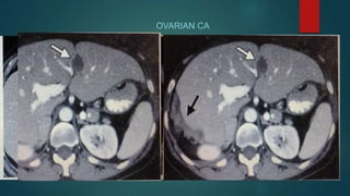OVARIAN CA
 