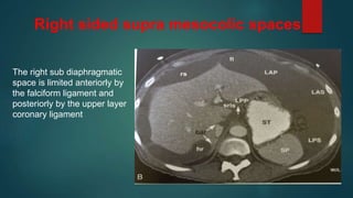 Right sided supra mesocolic spaces
The right sub diaphragmatic
space is limited anteriorly by
the falciform ligament and
posteriorly by the upper layer
coronary ligament
 