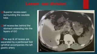 Lesser sac division
 Superior recess-seen
surrounding the caudate
lobe.
 Inf recess-lies behind the
stomach,extending into the
layers of GO
The sup & inf recess are
separated by a peritoneal fold
(ghl)that accompanies the left
gastric artery
 