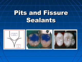 Pits and FissurePits and Fissure
SealantsSealants
 