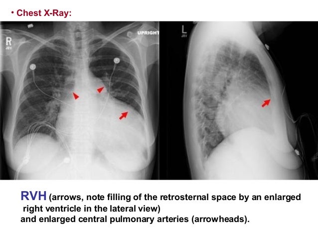 6 pulmonary hypertension