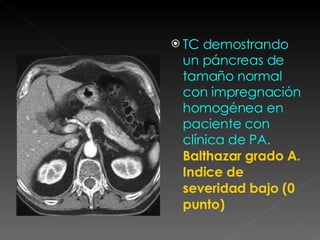 TC demostrando un páncreas de tamaño normal con impregnación homogénea en paciente con clínica de PA.  Balthazar grado A. Indice de severidad bajo (0 punto)  
