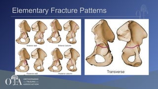 Letronel Classification 6_Radiographic Understanding, Evaluation & Classification of Acetabular ...