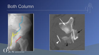 6_Radiographic Understanding, Evaluation & Classification of Acetabular ...