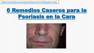 6 Remedios Caseros para la
Psoriasis en la Cara
http://remedioscaserosparalapsoriasis.blogspot.com/
 