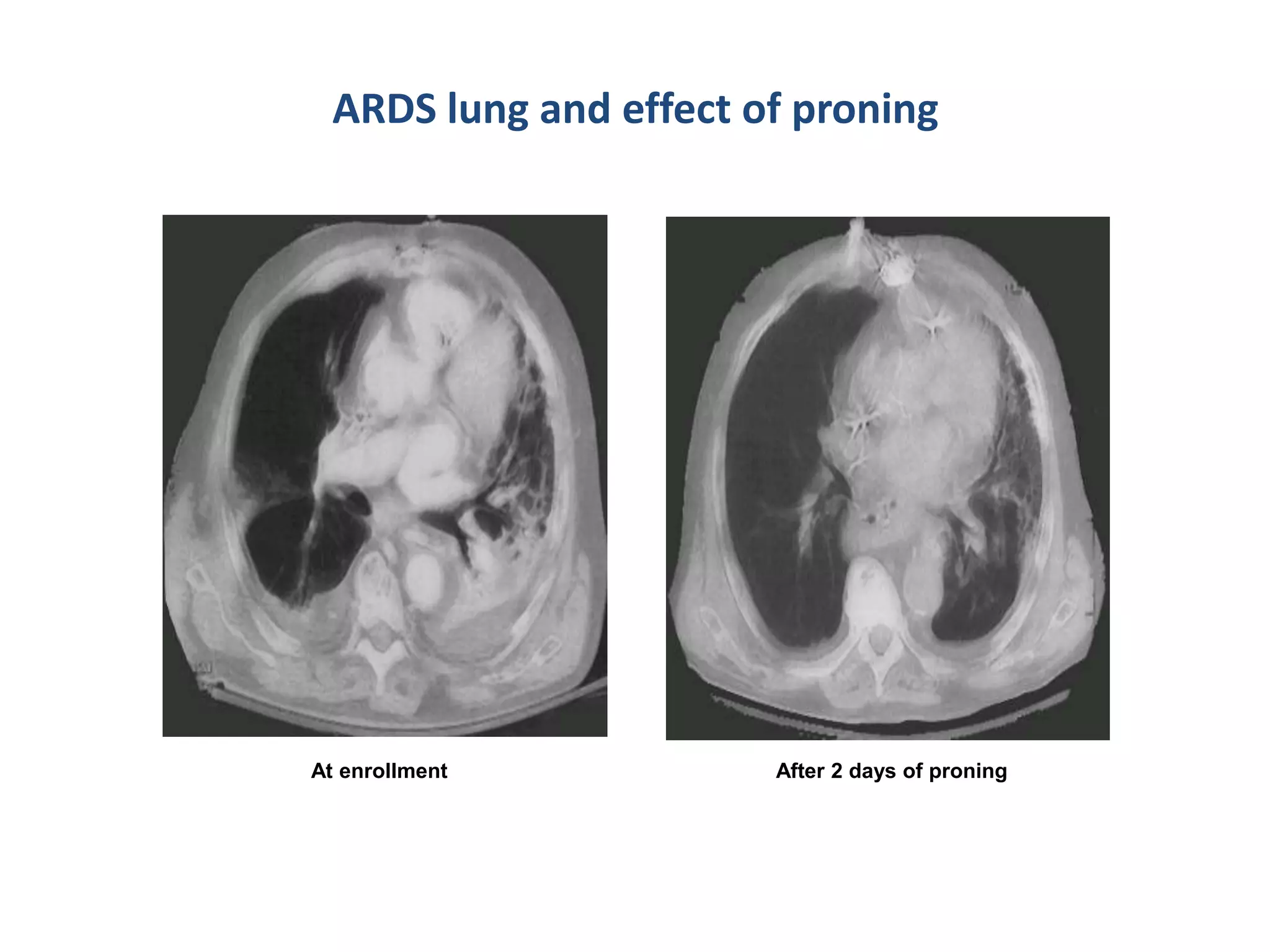 Algorithm Proning Ards 6) respiratory failure.pptx