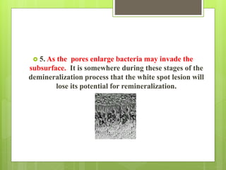  5. As the pores enlarge bacteria may invade the
subsurface. It is somewhere during these stages of the
demineralization process that the white spot lesion will
lose its potential for remineralization.
 