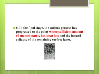  6. In the final stage, the carious process has
progressed to the point where sufficient amount
of enamel matrix has been lost and the inward
collapse of the remaining surface layer.
 