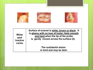 White
spot
Inactive
caries
Surface of enamel is white, brown or black. It
is glossy with no loss of luster; feels smooth
and hard when the tip of the probe
is gently moved across the surface (2).
The root/dentin lesion
is hard and may be dark.
 