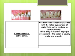 Cavitated lesion,
active caries.
Enamel/dentin cavity easily visible
with the naked eye;surface of
cavity feels soft or leathery on
gentle probing.
There may or may not be pulpal
involvement. The lesion is usually
moist and grayish.
 