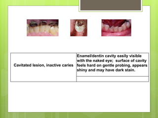 Cavitated lesion, inactive caries
Enamel/dentin cavity easily visible
with the naked eye; surface of cavity
feels hard on gentle probing, appears
shiny and may have dark stain.
 