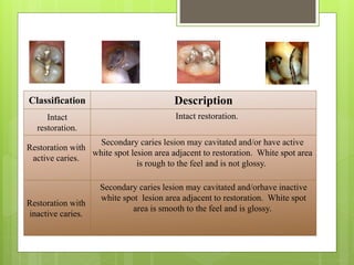 Classification Description
Intact
restoration.
Intact restoration.
Restoration with
active caries.
Secondary caries lesion may cavitated and/or have active
white spot lesion area adjacent to restoration. White spot area
is rough to the feel and is not glossy.
Restoration with
inactive caries.
Secondary caries lesion may cavitated and/orhave inactive
white spot lesion area adjacent to restoration. White spot
area is smooth to the feel and is glossy.
 