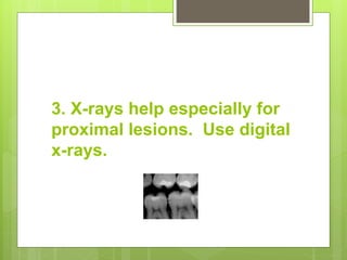 3. X-rays help especially for
proximal lesions. Use digital
x-rays.
 