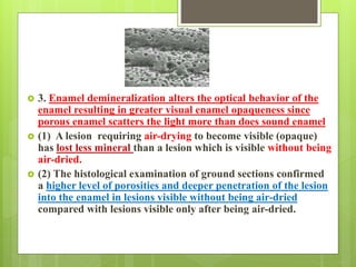  3. Enamel demineralization alters the optical behavior of the
enamel resulting in greater visual enamel opaqueness since
porous enamel scatters the light more than does sound enamel
 (1) A lesion requiring air-drying to become visible (opaque)
has lost less mineral than a lesion which is visible without being
air-dried.
 (2) The histological examination of ground sections confirmed
a higher level of porosities and deeper penetration of the lesion
into the enamel in lesions visible without being air-dried
compared with lesions visible only after being air-dried.
 