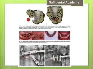 [6]role of avialable bone on dental implants [ 6 ] (3).pptx