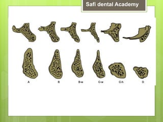 [6]role of avialable bone on dental implants [ 6 ] (3).pptx