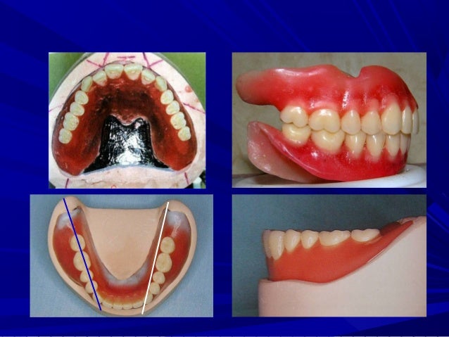teeth setting