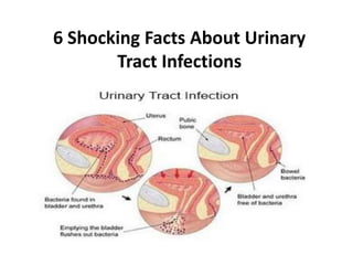 6 Shocking Facts About Urinary
Tract Infections
 