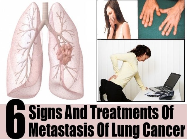6 Signs And Treatments Of Metastasis Of Lung Cancer