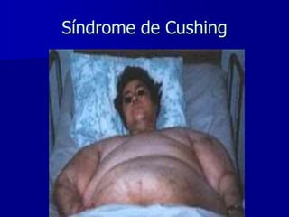 Síndrome de Cushing
 