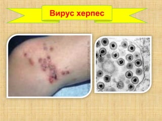 Вирус херпес
 