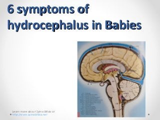 6 symptoms of6 symptoms of
hydrocephalus in Babieshydrocephalus in Babies
Learn more about Spina Bifida at
http://www.spinabifida.net
 