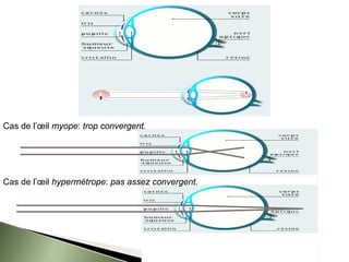 Cas de l’œil myope: trop convergent.
Cas de l’œil hypermétrope: pas assez convergent.
 