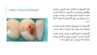 DIRECT PULP EXPOSURE ‫وو‬‫و‬‫و‬‫و‬‫و‬‫ی‬
‫وین‬‫و‬‫و‬‫و‬‫و‬‫ت‬‫دن‬‫و‬ ‫وریس‬‫و‬‫و‬‫و‬‫و‬‫ک‬ ‫وود‬‫و‬‫و‬‫و‬‫و‬ ‫اف‬‫ر‬‫و‬‫و‬‫و‬‫و‬‫و‬‫ط‬‫ا‬‫در‬‫ر‬‫ژ‬‫وپو‬‫و‬‫و‬‫و‬‫و‬‫س‬‫اک‬
‫د‬‫ر‬‫دا‬ ‫وریس‬‫و‬‫و‬‫و‬‫و‬‫و‬‫و‬‫و‬‫ک‬ ‫وه‬‫و‬‫و‬‫و‬‫و‬‫و‬‫و‬‫و‬‫ب‬ ‫واب‬‫و‬‫و‬‫و‬‫و‬‫و‬‫و‬‫و‬‫ص‬‫م‬ ‫وی‬‫و‬‫و‬‫و‬‫و‬‫و‬‫و‬‫و‬‫ب‬‫و‬‫مینر‬
‫وان‬‫و‬‫و‬‫و‬‫و‬‫و‬‫و‬‫و‬‫ش‬‫ن‬ ‫وه‬‫و‬‫و‬‫و‬‫و‬‫و‬‫و‬‫و‬‫ک‬
‫وپ‬‫و‬‫و‬‫و‬‫و‬‫و‬‫و‬‫ل‬‫پو‬‫و‬ ‫وه‬‫و‬‫و‬‫و‬‫و‬‫و‬‫و‬‫ش‬‫ی‬‫ر‬‫در‬ ‫وه‬‫و‬‫و‬‫و‬‫و‬‫و‬‫و‬‫ج‬‫تو‬ ‫ول‬‫و‬‫و‬‫و‬‫و‬‫و‬‫و‬‫ب‬‫قا‬ ‫واب‬‫و‬‫و‬‫و‬‫و‬‫و‬‫و‬‫ل‬‫الب‬ ‫وده‬‫و‬‫و‬‫و‬‫و‬‫و‬‫و‬‫ن‬‫ده‬
‫وو‬‫و‬‫و‬‫و‬‫ش‬ ‫د‬‫ر‬‫وو‬‫و‬‫و‬‫و‬‫م‬ ‫وا‬‫و‬‫و‬‫و‬‫ه‬‫ر‬‫ژ‬‫وپو‬‫و‬‫و‬‫س‬‫اک‬ ‫ووع‬‫و‬‫و‬‫و‬‫ن‬ ‫وع‬‫و‬‫و‬‫و‬‫ی‬‫ا‬ ‫ورمیم‬‫و‬‫و‬‫و‬‫ت‬ ‫وت‬‫و‬‫و‬‫س‬‫ا‬
‫است‬
‫وده‬‫و‬‫و‬‫و‬‫و‬‫و‬‫و‬‫ن‬‫ده‬ ‫وان‬‫و‬‫و‬‫و‬‫و‬‫و‬‫و‬‫ش‬‫ن‬ ‫اوان‬‫ر‬‫و‬‫و‬‫و‬‫و‬‫و‬‫و‬‫و‬‫ف‬ ‫ی‬‫وونریز‬‫و‬‫و‬‫و‬‫و‬‫و‬‫و‬ ‫وا‬‫و‬‫و‬‫و‬‫و‬‫و‬‫و‬‫ب‬‫ر‬‫ژ‬‫وپو‬‫و‬‫و‬‫و‬‫و‬‫و‬‫و‬‫س‬‫اک‬
‫ا‬ ‫بعید‬ ‫آن‬ ‫ترمیم‬ ‫بوده‬ ‫پولپ‬ ‫یاد‬‫ز‬ ‫مصابیت‬
‫ست‬
‫ده‬ ‫وان‬‫و‬‫ش‬‫ن‬ ‫ت‬‫ر‬‫ا‬‫ر‬‫و‬‫و‬‫ح‬‫و‬ ‫وابی‬‫و‬‫ل‬‫الب‬ ‫وایا‬‫و‬‫م‬ ‫وا‬‫و‬‫ب‬‫ر‬‫ژ‬‫وپو‬‫و‬‫س‬‫اک‬
‫وده‬‫و‬‫ن‬
‫وه‬‫و‬‫و‬‫و‬‫و‬‫و‬‫و‬‫و‬‫ش‬‫ی‬‫ر‬ ‫وا‬‫و‬‫و‬‫و‬‫و‬‫و‬‫و‬‫و‬‫ن‬‫کا‬‫و‬ ‫وپ‬‫و‬‫و‬‫و‬‫و‬‫و‬‫و‬‫ل‬‫پو‬ ‫وب‬‫و‬‫و‬‫و‬‫و‬‫و‬‫و‬‫و‬‫ی‬‫تخر‬ ‫ودید‬‫و‬‫و‬‫و‬‫و‬‫و‬‫و‬‫و‬‫ش‬ ‫واب‬‫و‬‫و‬‫و‬‫و‬‫و‬‫و‬‫ل‬‫الب‬
‫است‬ ‫ممنع‬‫غیر‬ ‫آن‬ ‫ترمیم‬ ‫که‬ ‫میباشد‬
 