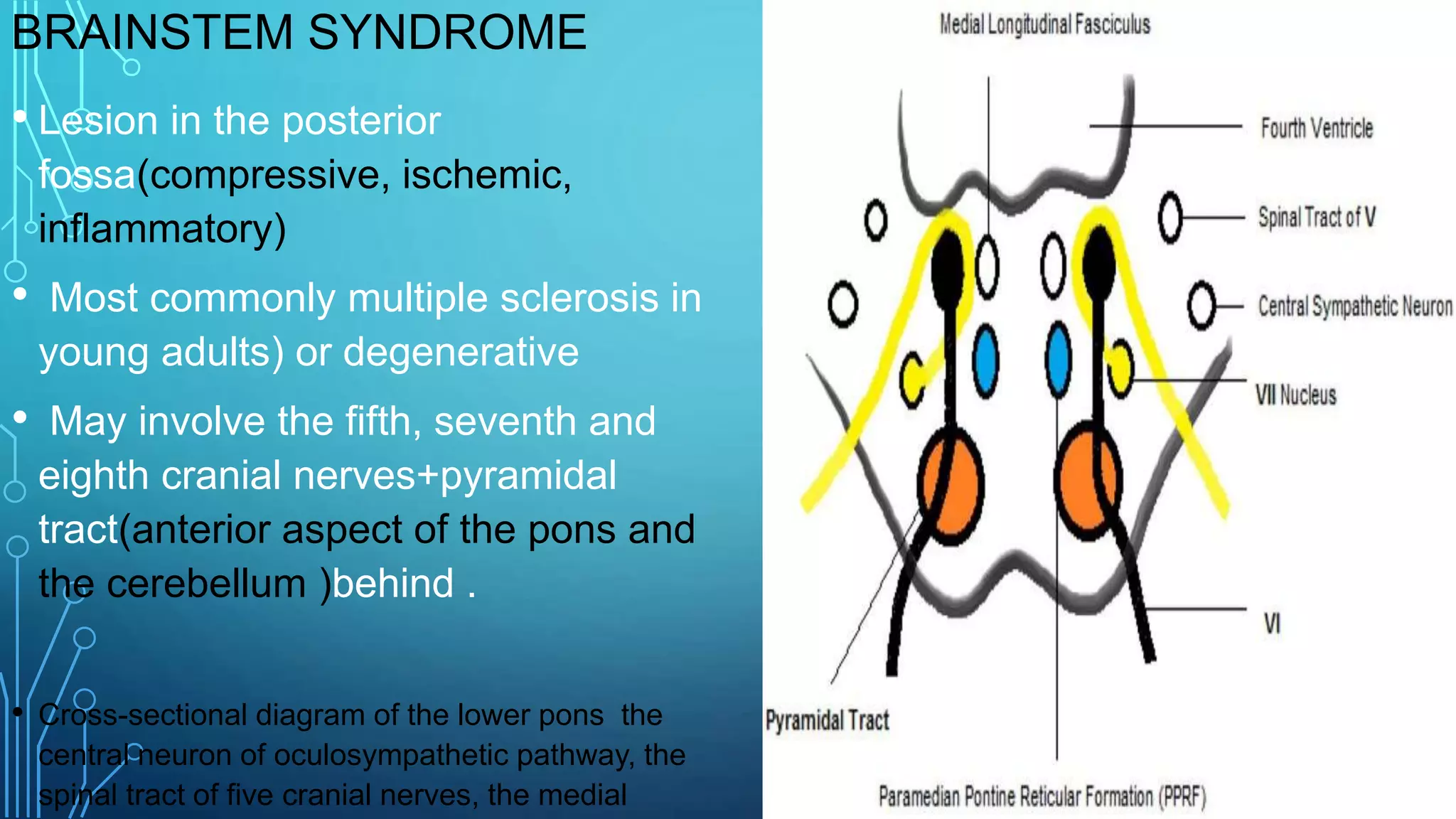 6 th nerve palsy | PPTX