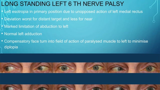 6 th nerve palsy | PPTX | Ear, Nose and Throat Conditions | Diseases ...