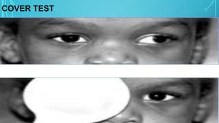 6 th nerve palsy | PPTX
