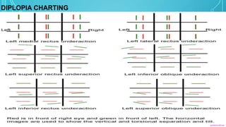 Diplopia Charting Examples 6 th nerve palsy | PPTX