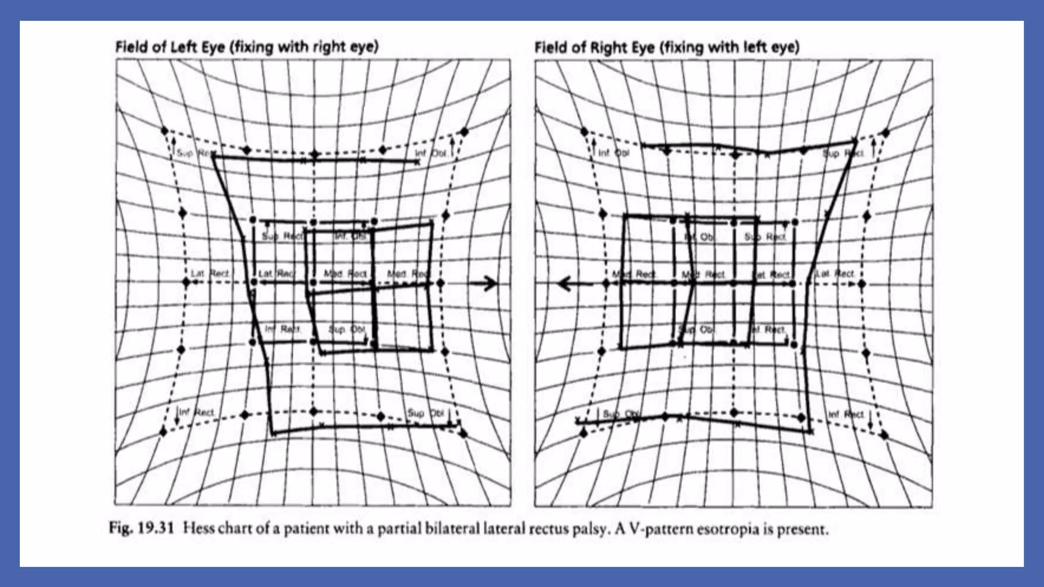 6th Nerve Palsy | PPTX