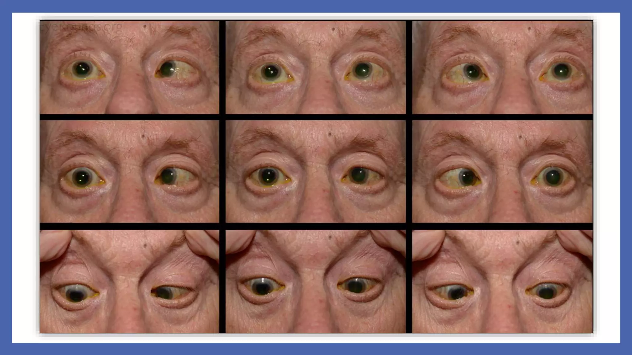 6th Nerve Palsy | PPTX