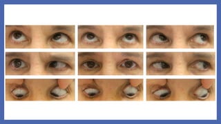 6th Nerve Palsy | PPTX