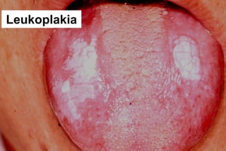 Leukoplakia
 