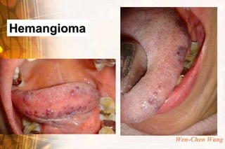 Hemangioma




             Wen-Chen Wang
 