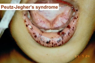 Peutz-Jegher’s syndrome
 