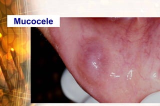 Mucocele
 