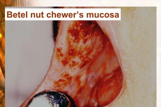 Betel nut chewer’s mucosa
 