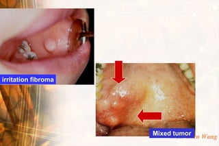irritation fibroma




                     MixedWen-Chen Wang
                          tumor
 